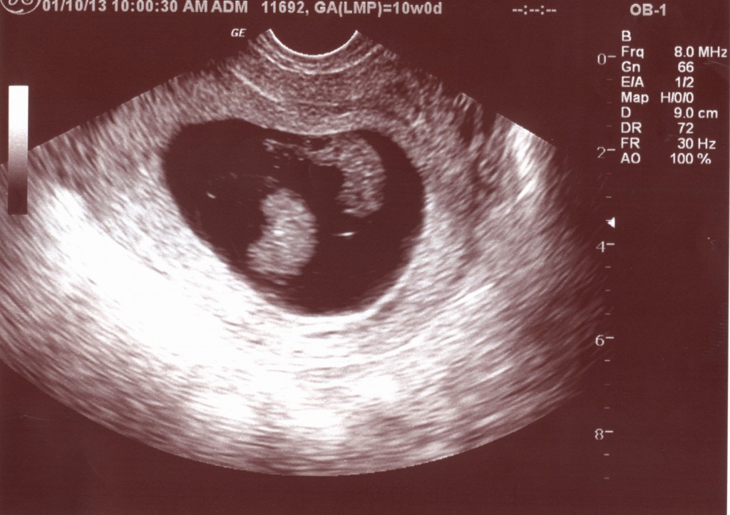 Twins at 9 Week Ultrasound